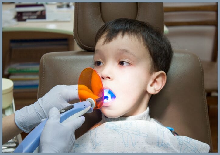 Child receiving a dental sealant treatment with curing light to protect molars from cavities.